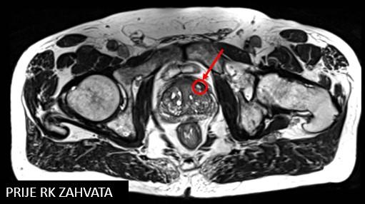 Prostata